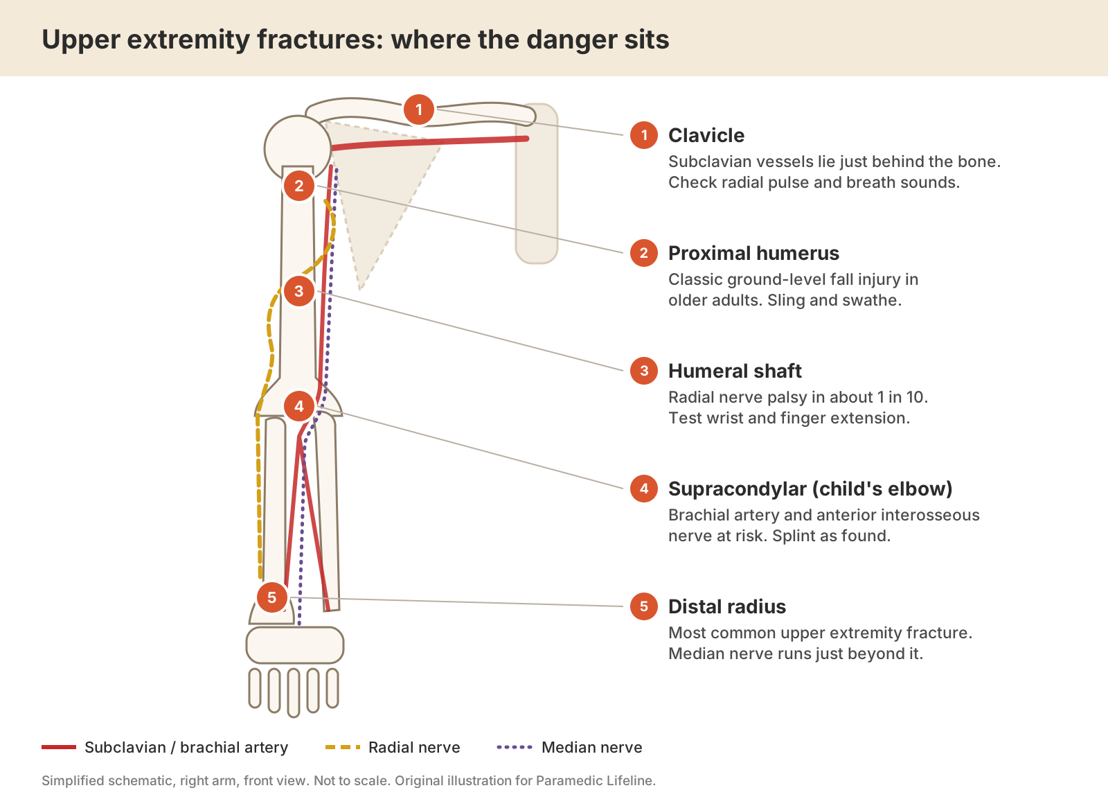 Schematic of the right arm showing five common fracture sites and the artery and nerves at risk at each